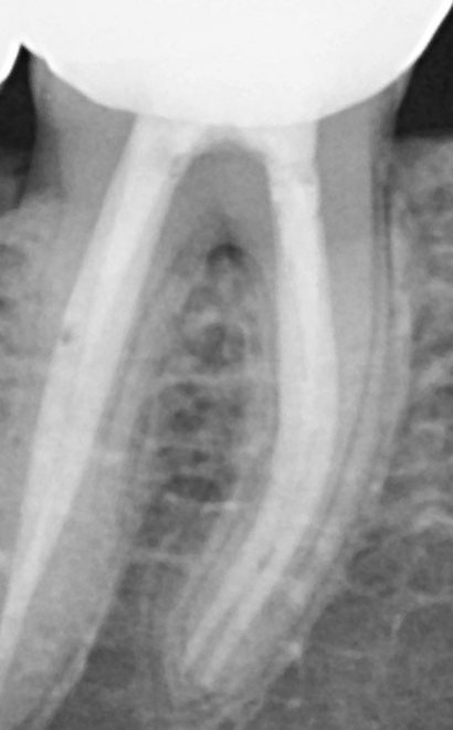 약 10개월 뒤 엑스레이